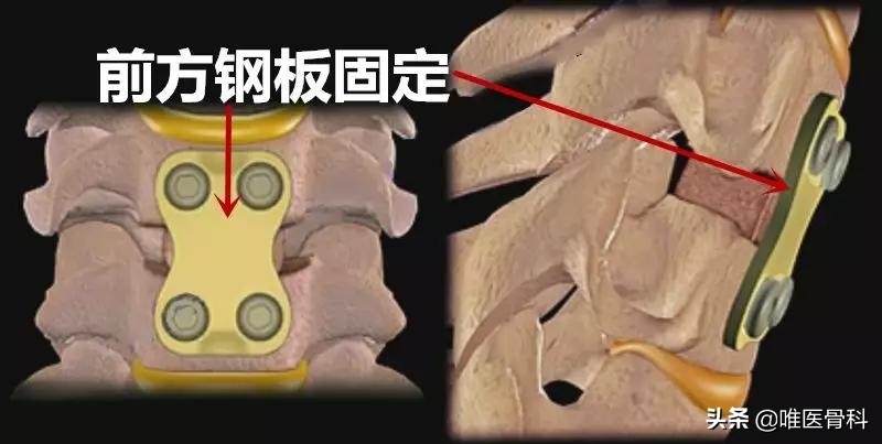 颈椎病做手术哪种方式最好,开放手术和微创手术的区别