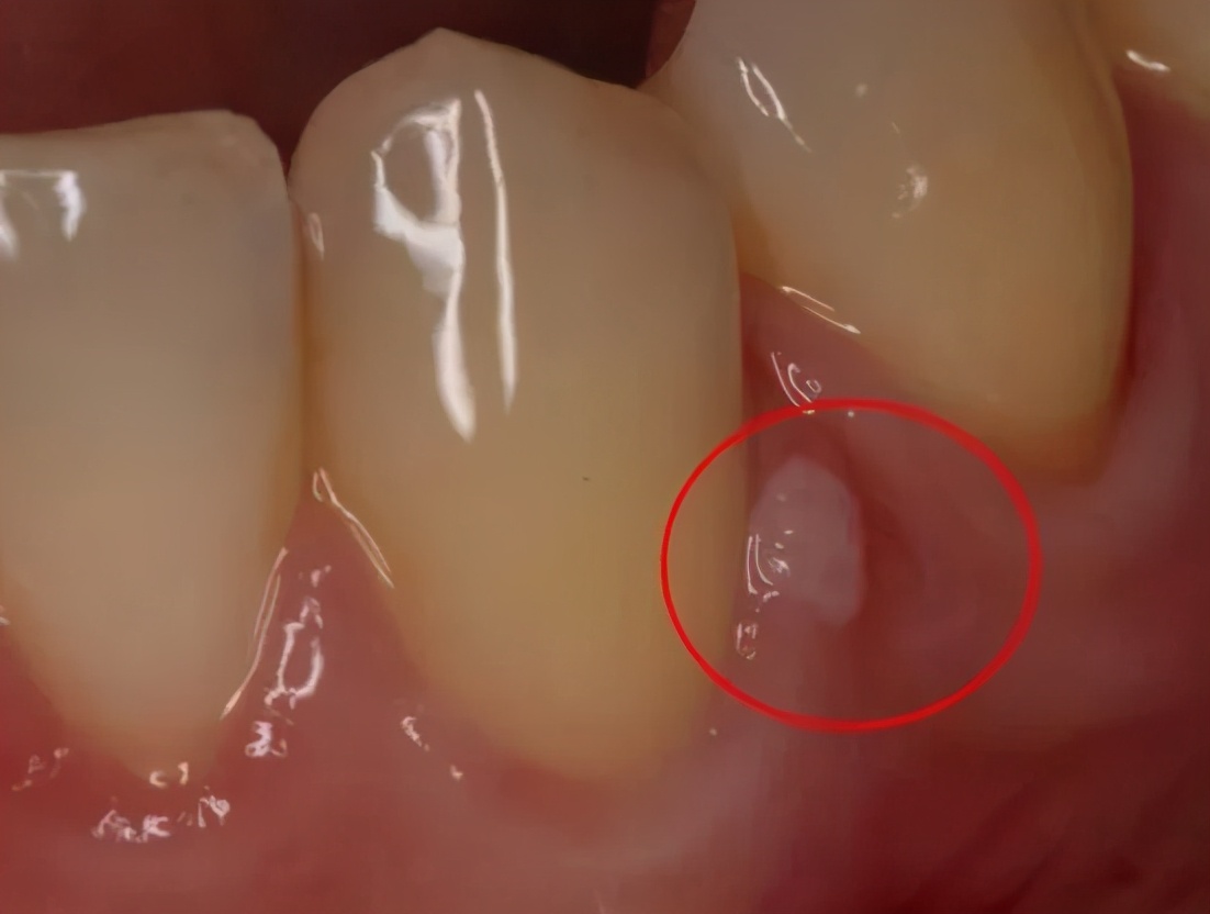 牙龈长脓包用针挑破又长脓包,牙龈肿了一个脓包要挤掉吗