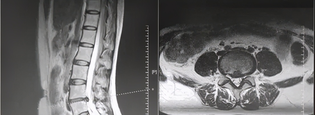 医林正骨丨妙手治腿痛，腰椎间盘突出名中医有绝招