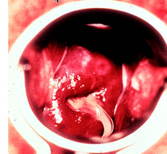 宫颈炎为什么医生说不需要治疗,为什么有宫颈炎医生不给开药