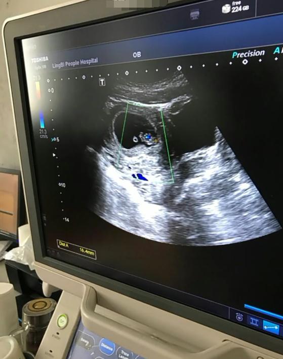 B超检查是男宝，宝爸盼女儿希望翻盘，为啥医生说有点困难？懂了