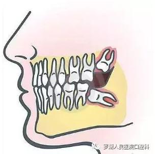 不想拔智齿但很疼怎么办,不想拔智齿想磨掉一部分怎么样