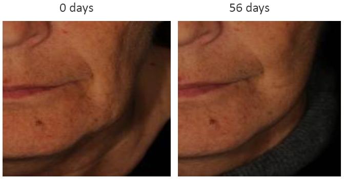 棕榈酰三肽-38淡化唇纹Matrixylsynthe6