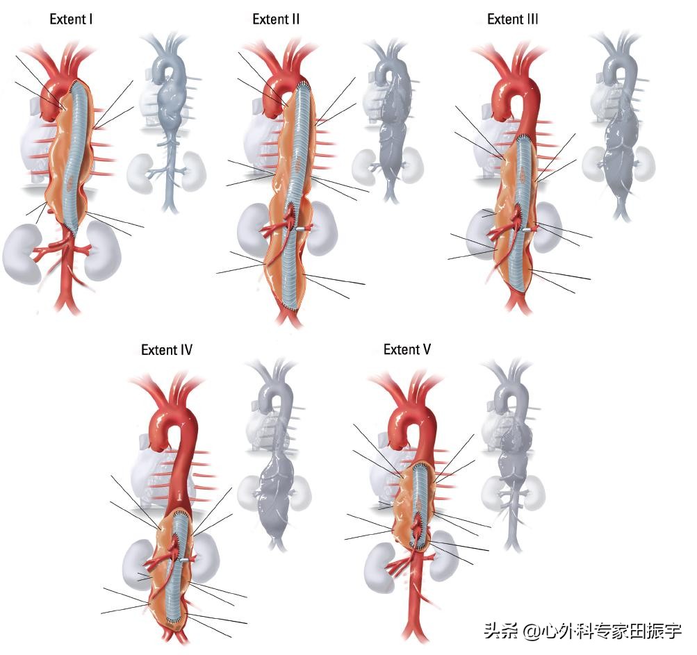 胸主动脉瘤最常见的护理措施,胸主动脉疾病
