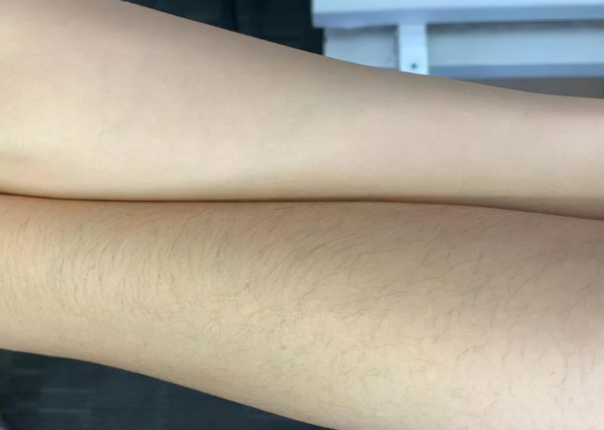 女性体毛重的症状,女性体毛多是什么原因造成的