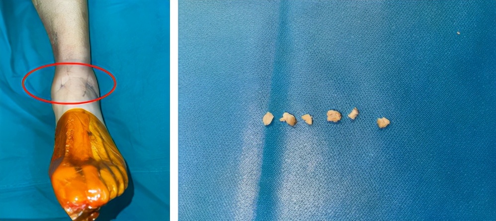 22岁脚踝创伤性关节炎,67岁老人扭伤脚踝