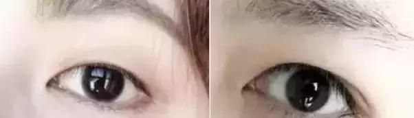 肿眼泡是什么原因啊,肿眼泡怎么贴双眼皮