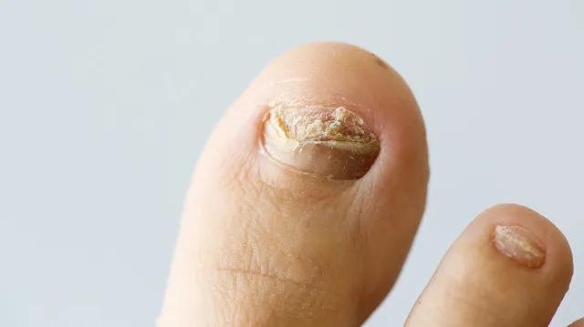 什么药膏能彻底把灰指甲治好,想治好灰指甲非要吃药吗