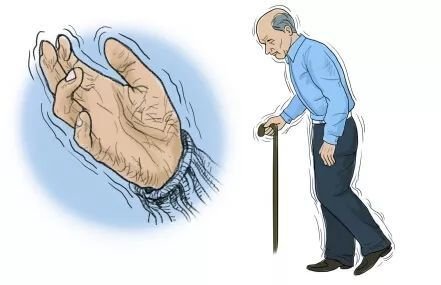 老年人帕金森手抖怎么缓解症状,老年人手抖是什么病的预兆和症状