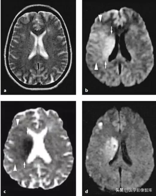 双侧额叶皮层区dwi偏高是什么意思,颅内dwi高信号病变