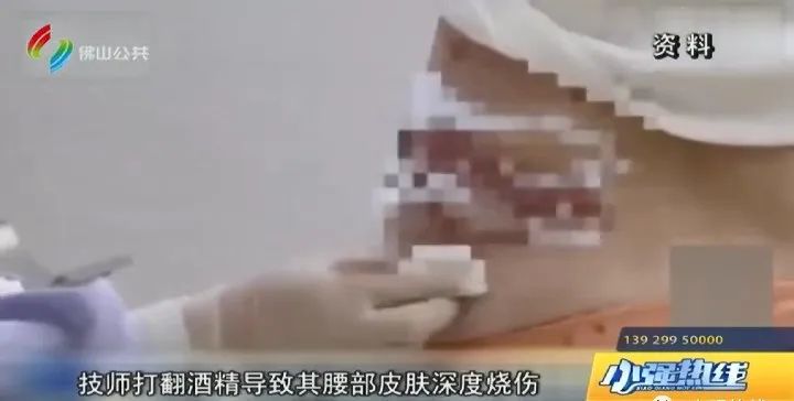 去美容院拔火罐被大面积烧伤,佛山拔火罐烧伤