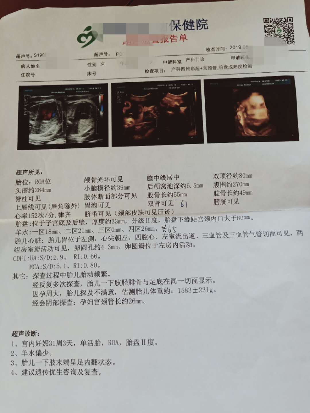 胎儿左足呈内翻状,左足马蹄内翻