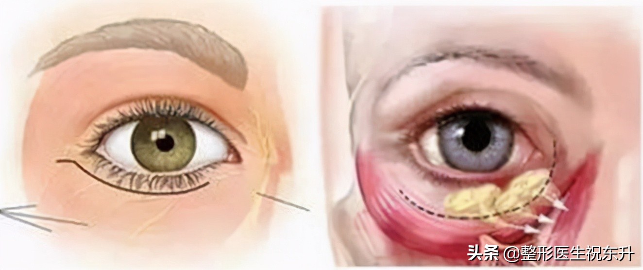 有眼袋、泪沟该怎么办？医生为你支个招