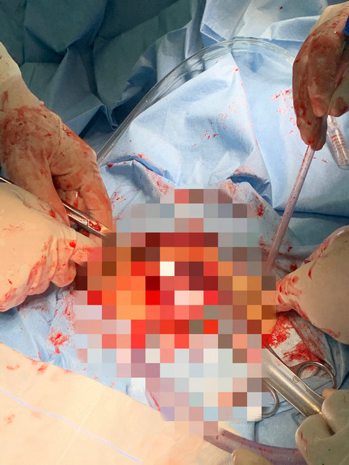 宫外孕破裂失血性休克教学查房,宫外孕破裂大出血的抢救