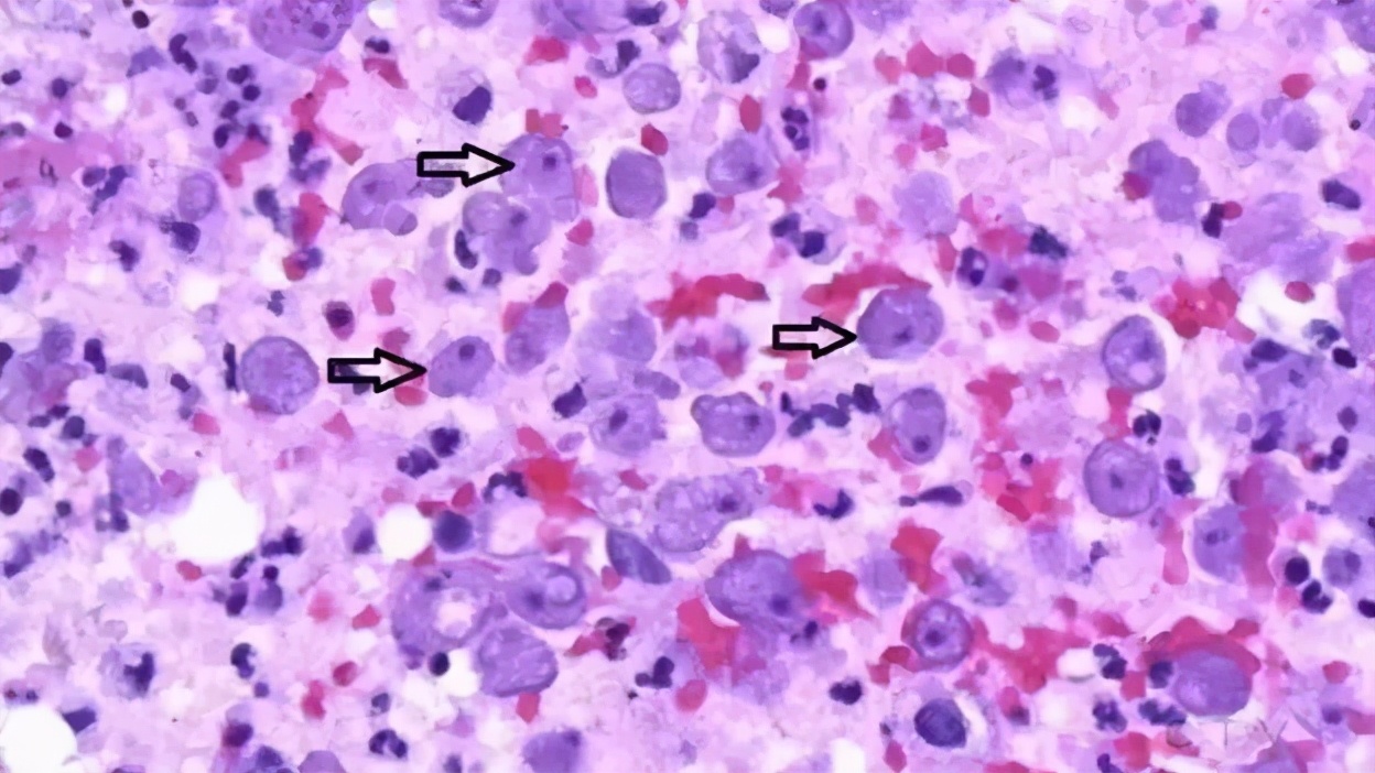 洗鼻生理盐水可以用自来水配吗,可以用自来水烧开兑洗鼻盐洗鼻吗