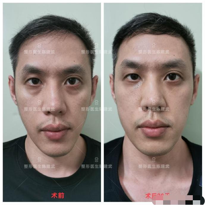 去眼袋泪沟医美方法,想了解一下去眼袋的最佳方法