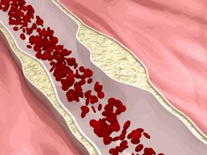 都是脑梗，一个瘫了，一个活蹦乱跳，日本专家解释的明明白白