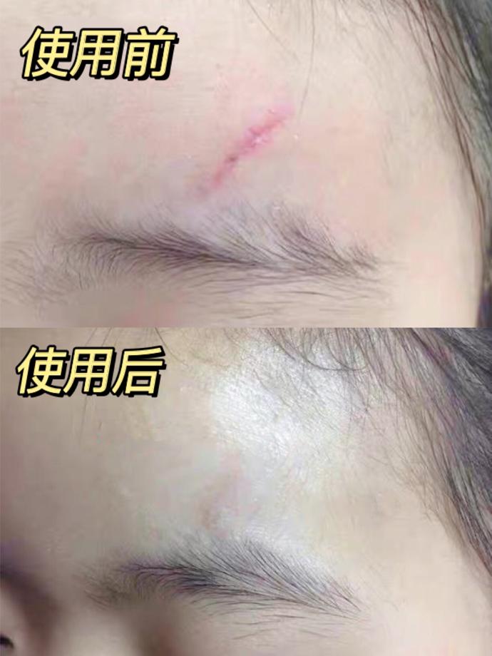 巴立清疤痕凝胶效果如何,疤痕凝胶是什么原理