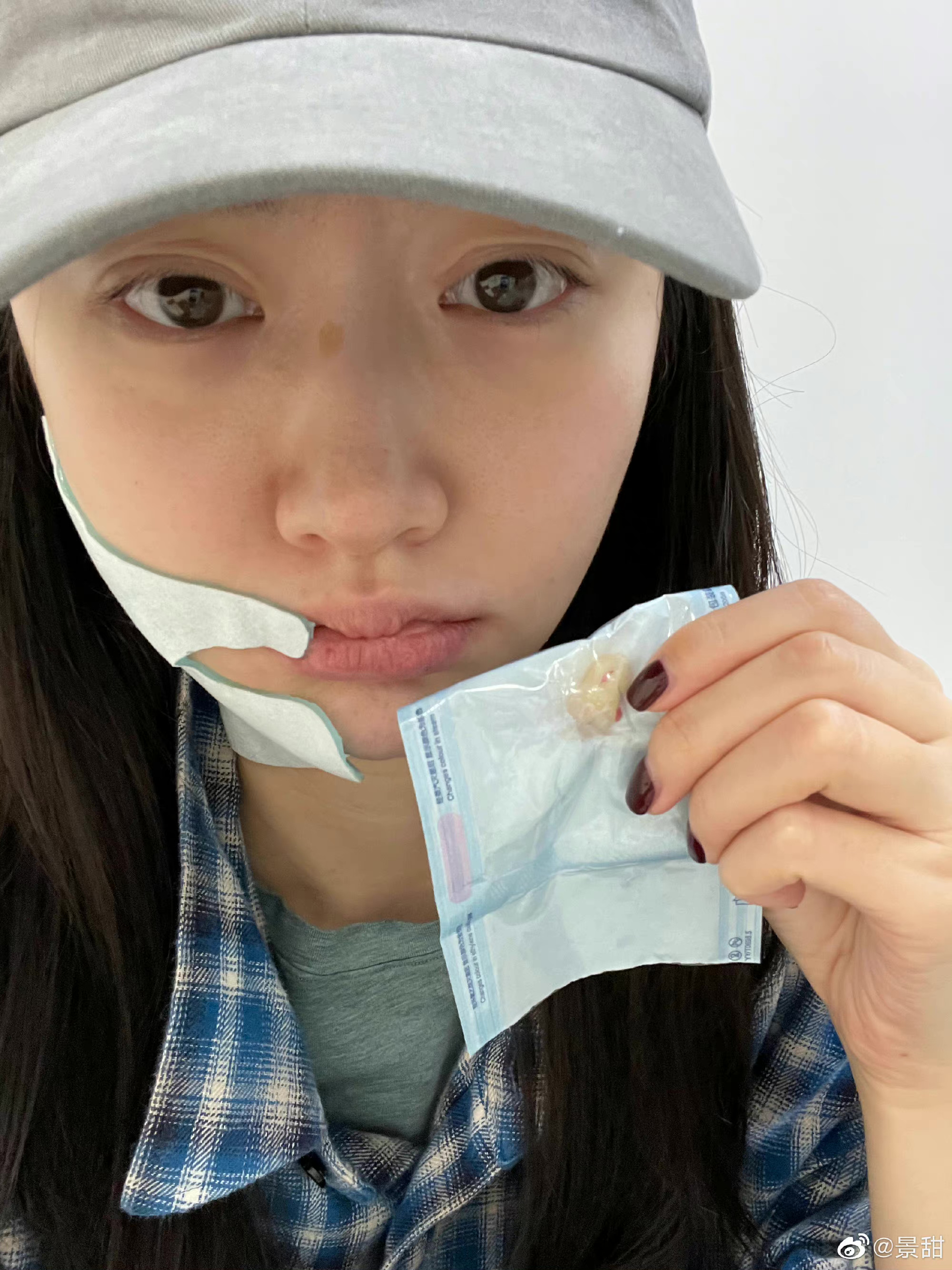 景甜拔牙后自拍照,景甜拔牙后的自拍照