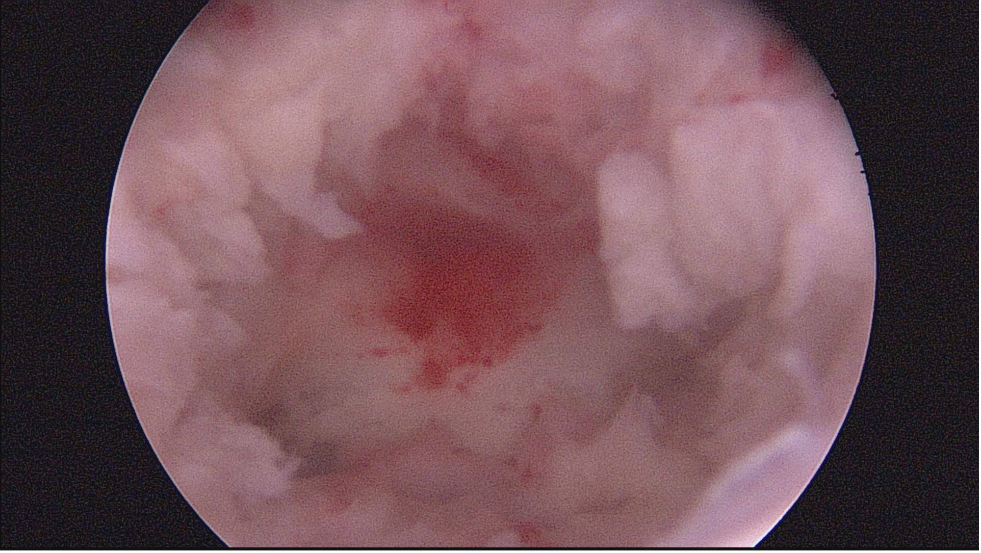 安徽宫腔镜手术专家排名,安徽省立宫腔镜哪个医生做的好