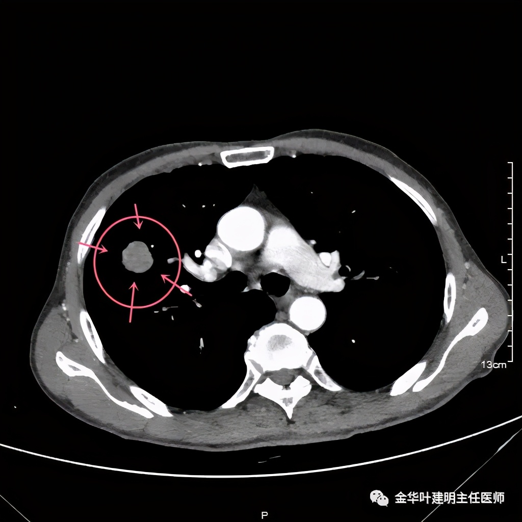 左肺占位被安排穿刺活检是肺癌吗,肺癌肺部穿刺有什么危险