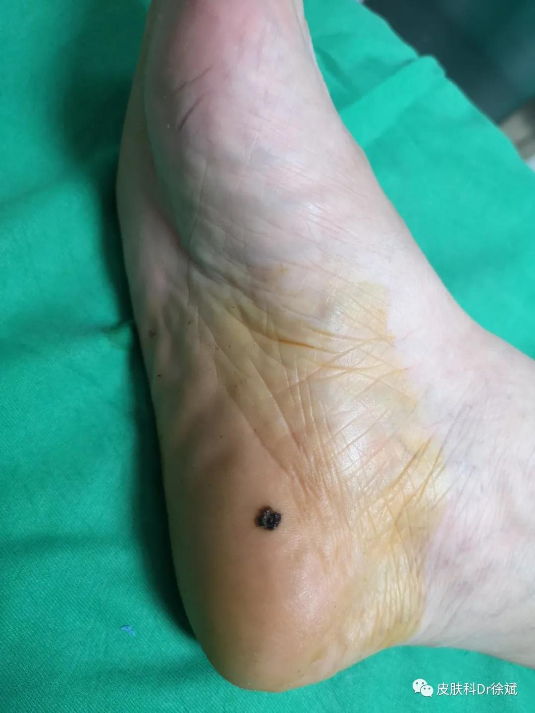 脚底所有黑痣都得切除吗,16岁脚底板长了黑痣一定要切除吗