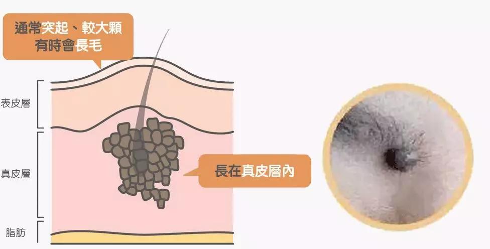 长在什么部位的痣最危险,长在哪些部位的痣需要特别注意