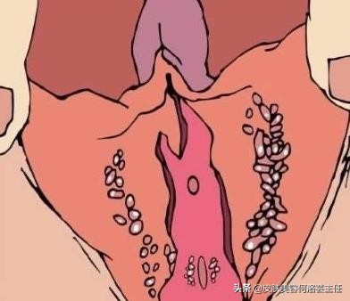 假性尖锐性湿疣可以不用治疗,假性尖锐湿疣很普遍吗