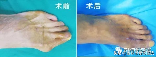 大脚骨会带来哪些危害,割大脚骨的危害