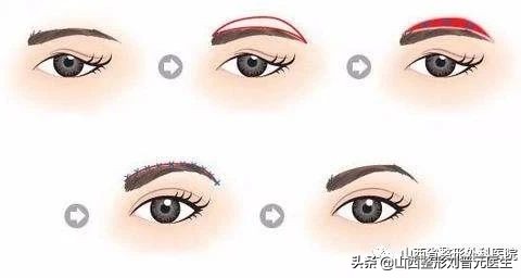 埋线双眼皮会越来越窄,埋线双眼皮越来越窄怎么办