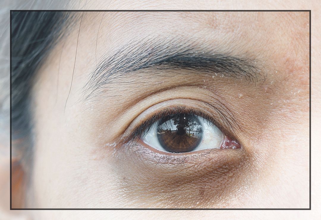 花了10800块去黑眼圈没效果,网上治疗黑眼圈靠谱么