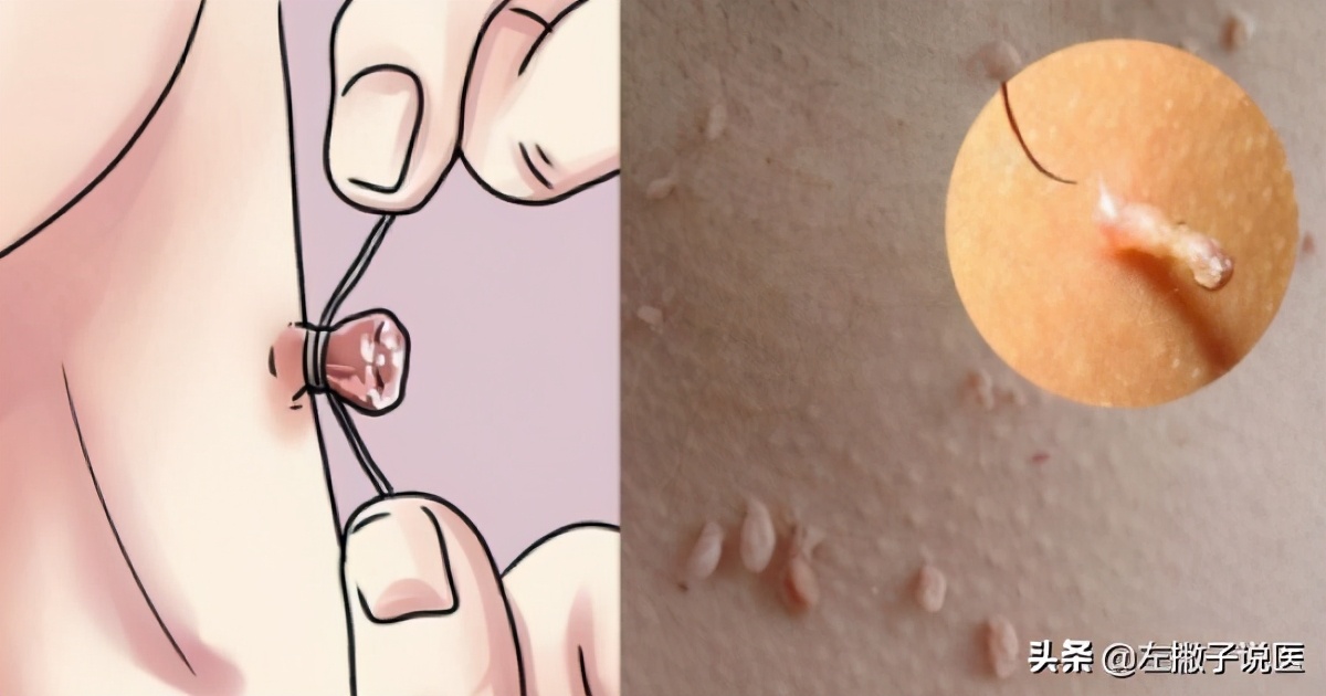 脖子上的小肉球怎么处理掉,脖子上小的肉球拿什么抹掉