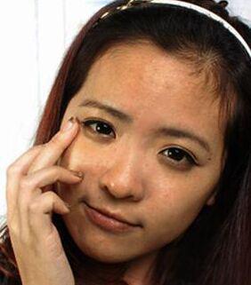 橘皮型毛孔粗大,黄细纹毛孔粗大