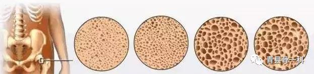 骨密度低怎么办这些原因要清楚,骨密度低有什么办法治疗吗
