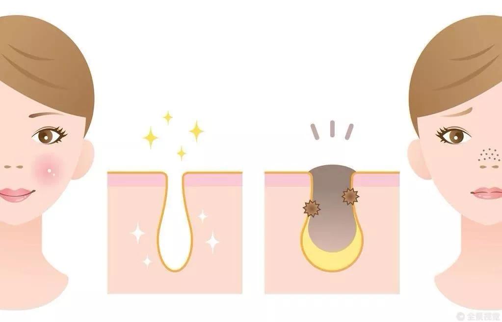 酒糟鼻用甲硝唑凝胶多长时间能好,酒糟鼻用甲硝唑凝胶鼻头会变小吗