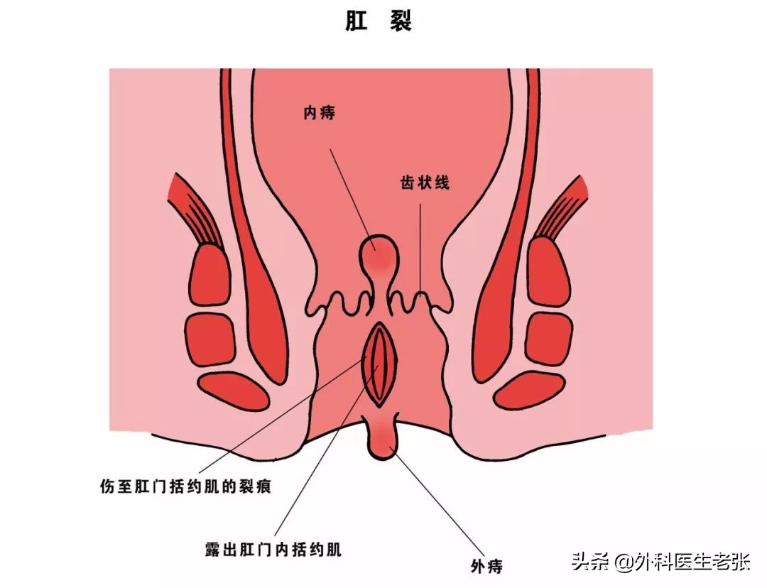 三岁孩子肛裂是怎么治疗,三岁小孩肛裂怎么治