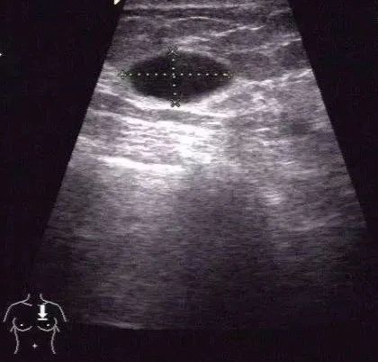 乳腺囊肿导致乳房阵阵刺痛,乳腺增生乳房有囊肿怎么治疗