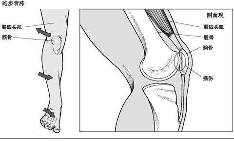 髌骨经常脱位?医生:这4种原因导致,有的人只要一蹲下就脱位