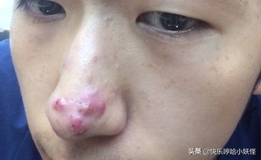 鼻子上长痘是哪里火气重,鼻子起闷头是哪里火大