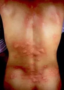 麻疹有什么治疗方法,麻疹和荨麻疹的区别在哪里