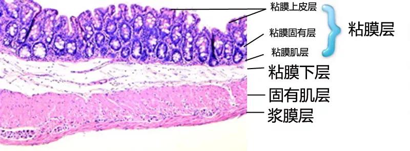上皮内瘤变是肿瘤吗,什么是上皮鳞状病变
