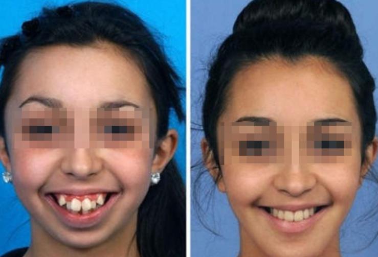 什么年龄段做牙齿矫正最好,几岁进行牙齿矫正比较合适