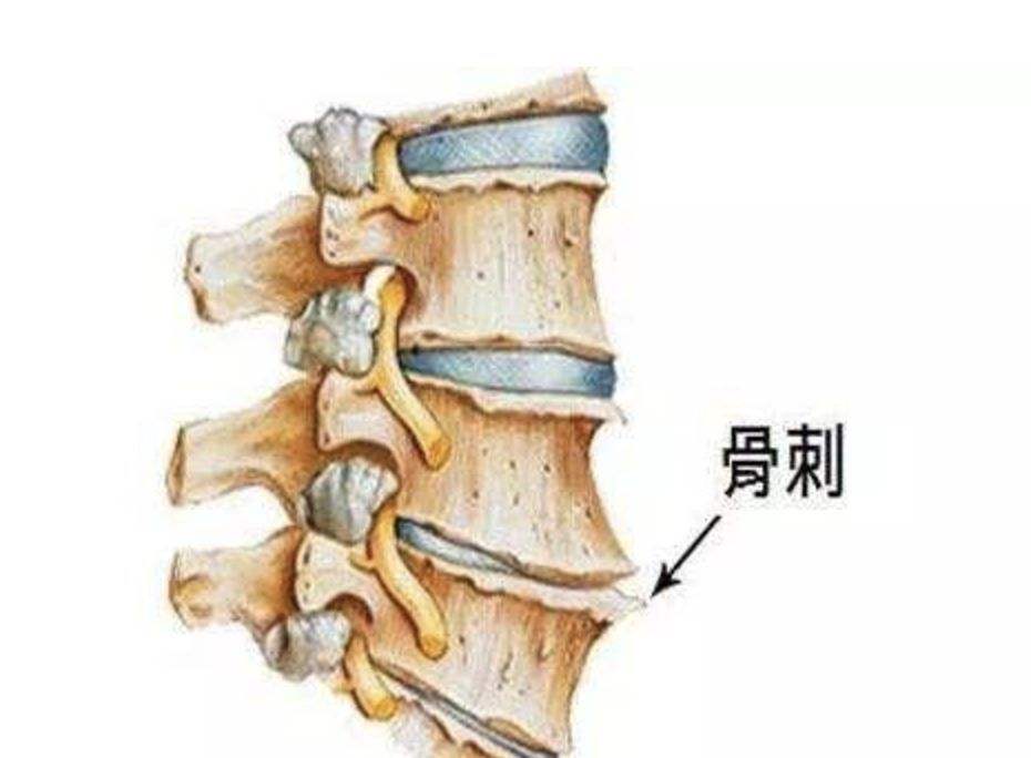 骨刺怎么治才能彻底根除骨质增生,脚脖子骨质增生有骨刺能贴膏药吗