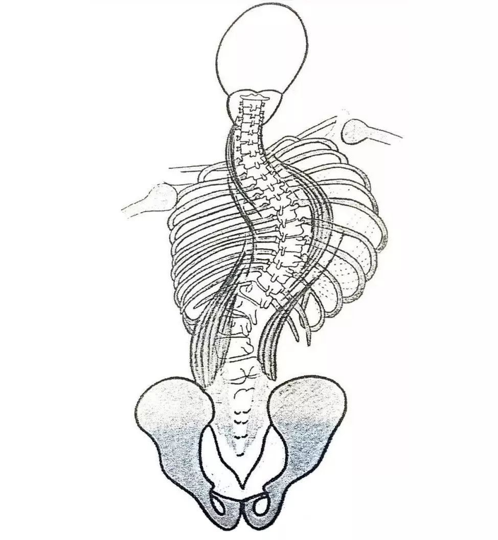 正美体态改善扁头是真的吗,成年人脊柱侧弯能恢复正常体态吗