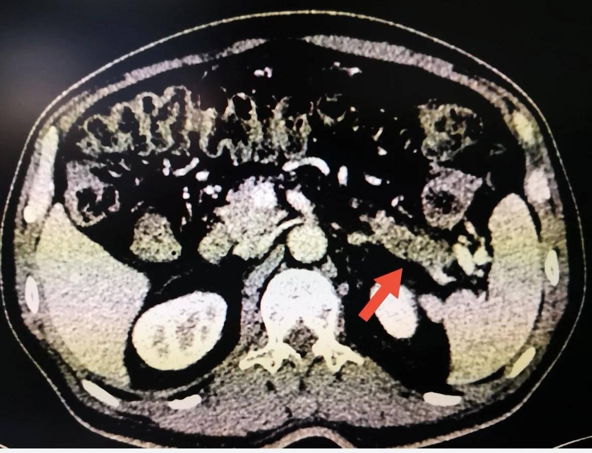 腹腔镜胰体尾切除术打孔位置,胰体尾肿瘤切除后复查哪些