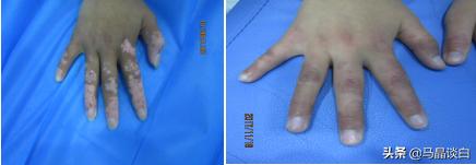 肢端型白癜风能彻底治愈吗,肢端型白癜风的治疗重点有哪些