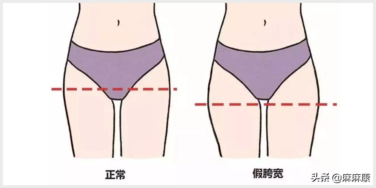 怎么改善产后假胯,消除产后假胯宽