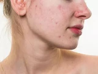 皮肤有斑有痘要做什么样的护理呢,有斑有细纹长痘是什么皮肤