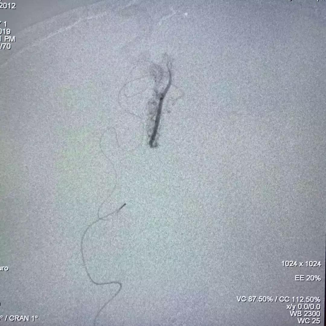 北京三博脑科医院康复治疗,北京三博脑科医院治脑血管瘤怎样