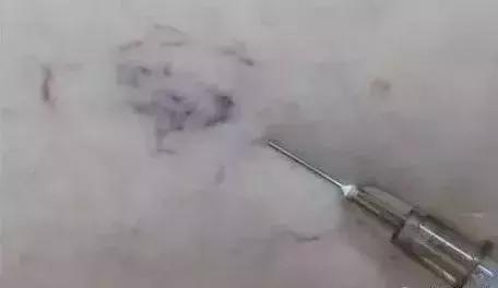 腿上有蚯蚓纹怎么回事,腿上出现蚯蚓似的纹路是怎么回事